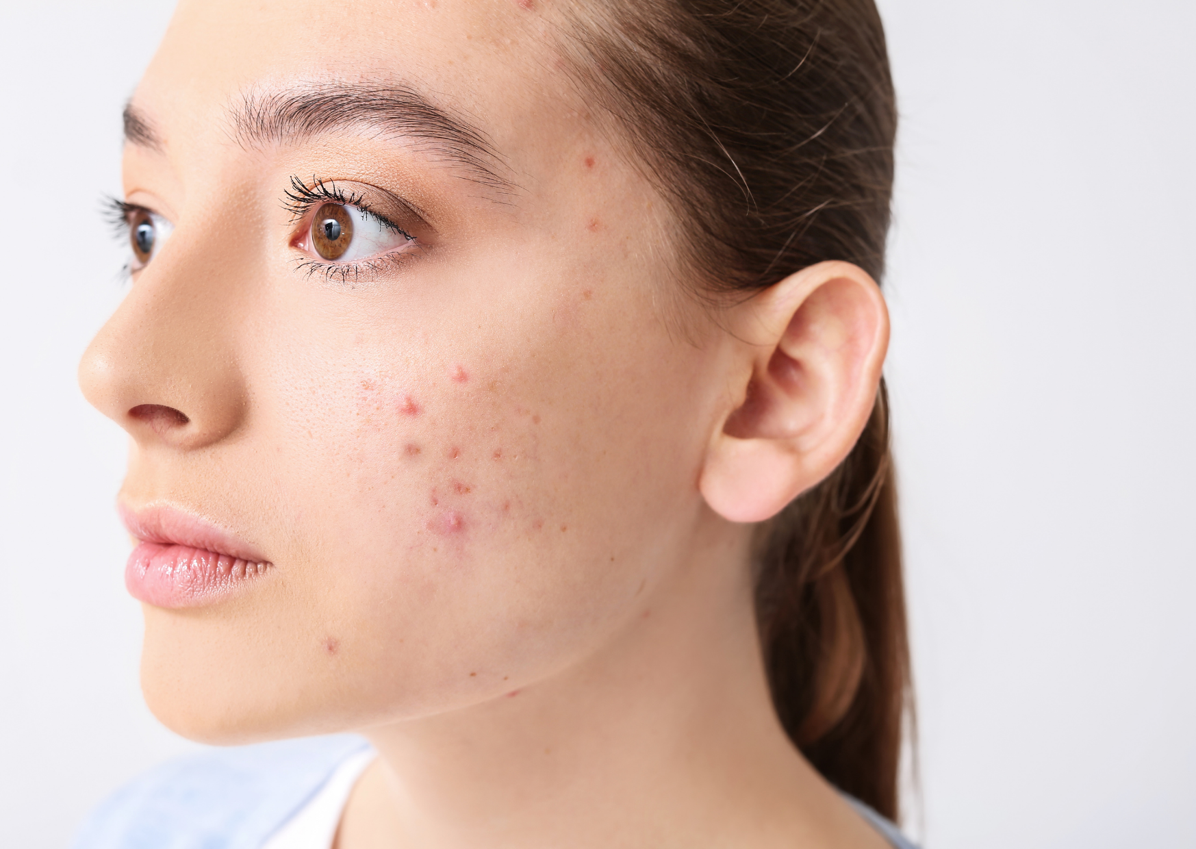 Een litteken van acne voorkomen, een dame met acne op haar wang