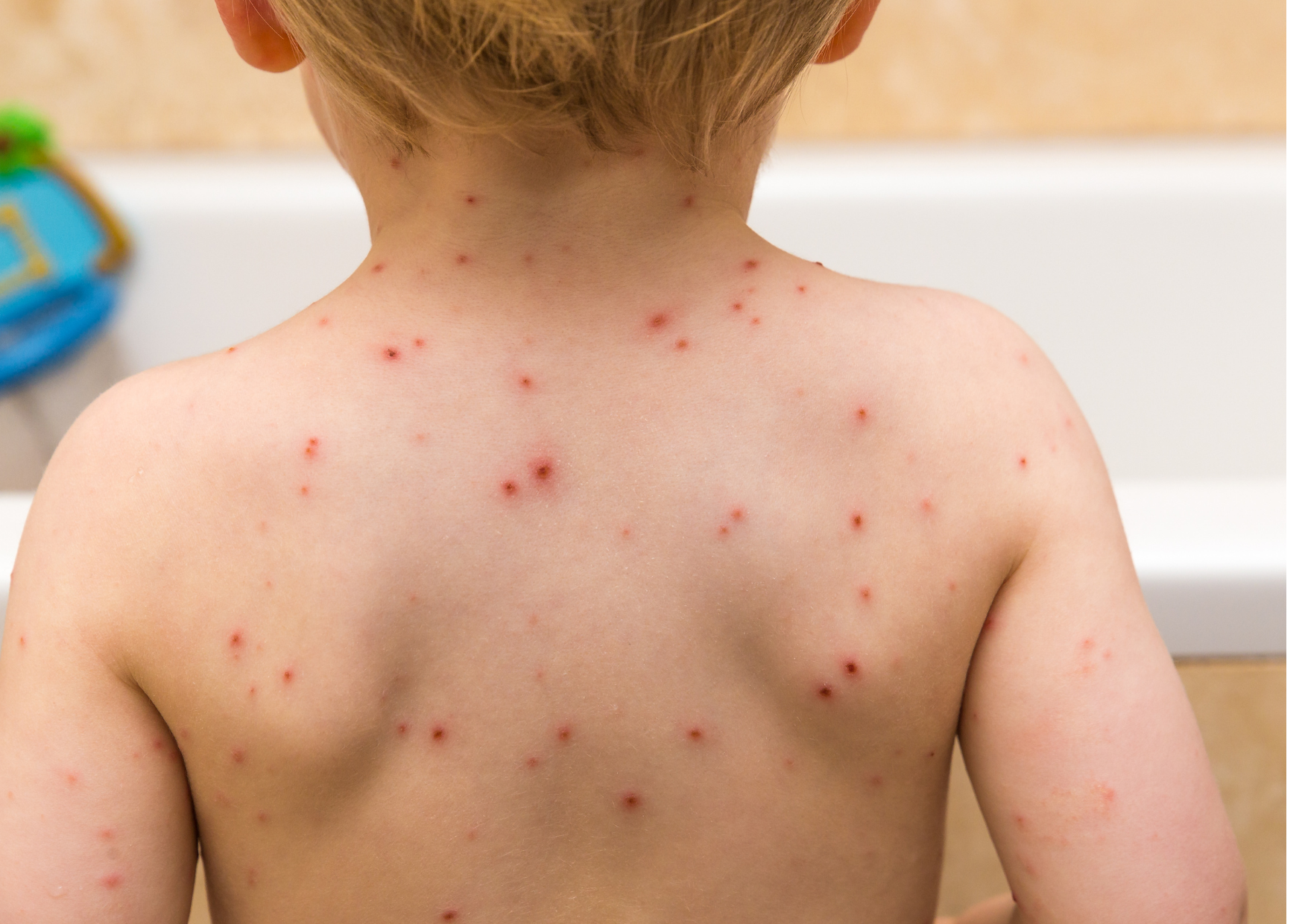 Waterpokken op de rug van een kind die kunnen leiden tot littekens
