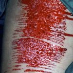 Huidtransplantatie (split-skin graft), direct na OK.