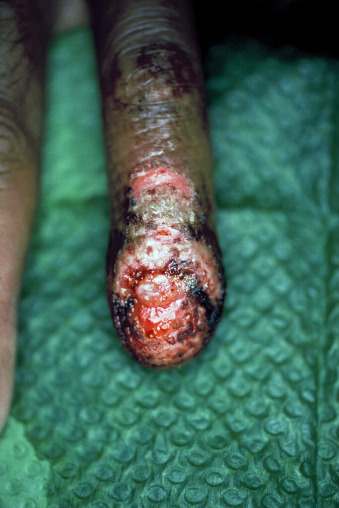 Infectie nagelriem, nagel verwijderd.