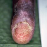 Infectie nagelriem, nagel verwijderd. Na 4 weken gebruik van Edula® Zalf.