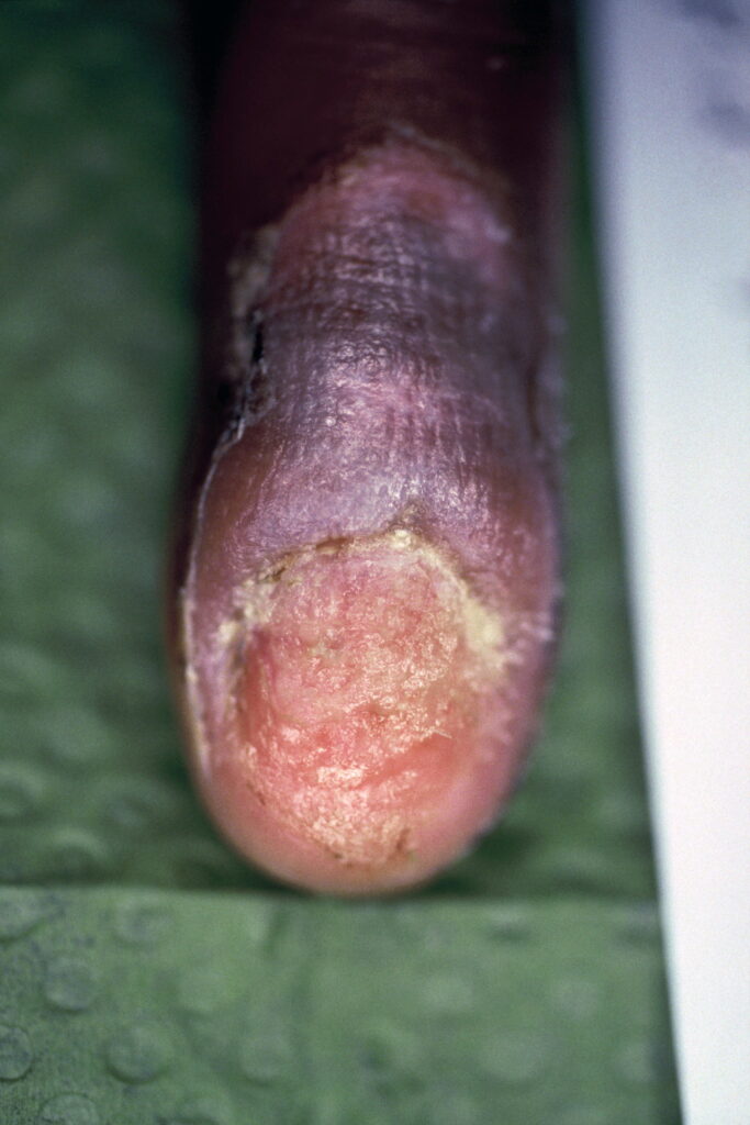 Infectie nagelriem, nagel verwijderd. Na 4 weken gebruik van Edula® Zalf.