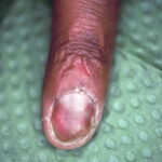 Infectie nagelriem, nagel verwijderd. Eindresultaat na 10 weken gebruik van Edula® Zalf.