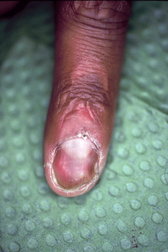 Infectie nagelriem, nagel verwijderd. Eindresultaat na 10 weken gebruik van Edula® Zalf.