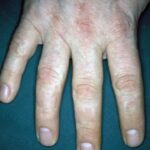 Resultaat na 2 maanden Edula® Zalf onder occlusie na trauma met een cirkelzaag aan de ringvinger