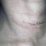 vrouw, resultaat na 5 maanden (3 maanden 2 x per dag Edula® Zalf onder occlusie). Na schildklier operatie, hypertrofisch litteken in de hals.