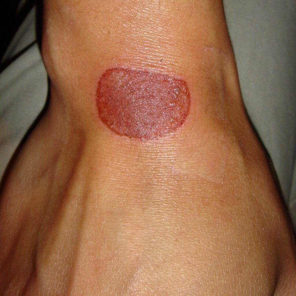 Lipoom (vetbult) op pols verwijderd.