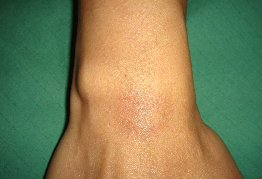 Lipoom (vetbult) op pols verwijderd, eindresultaat na 8 weken gebruik van Edula® Zalf.