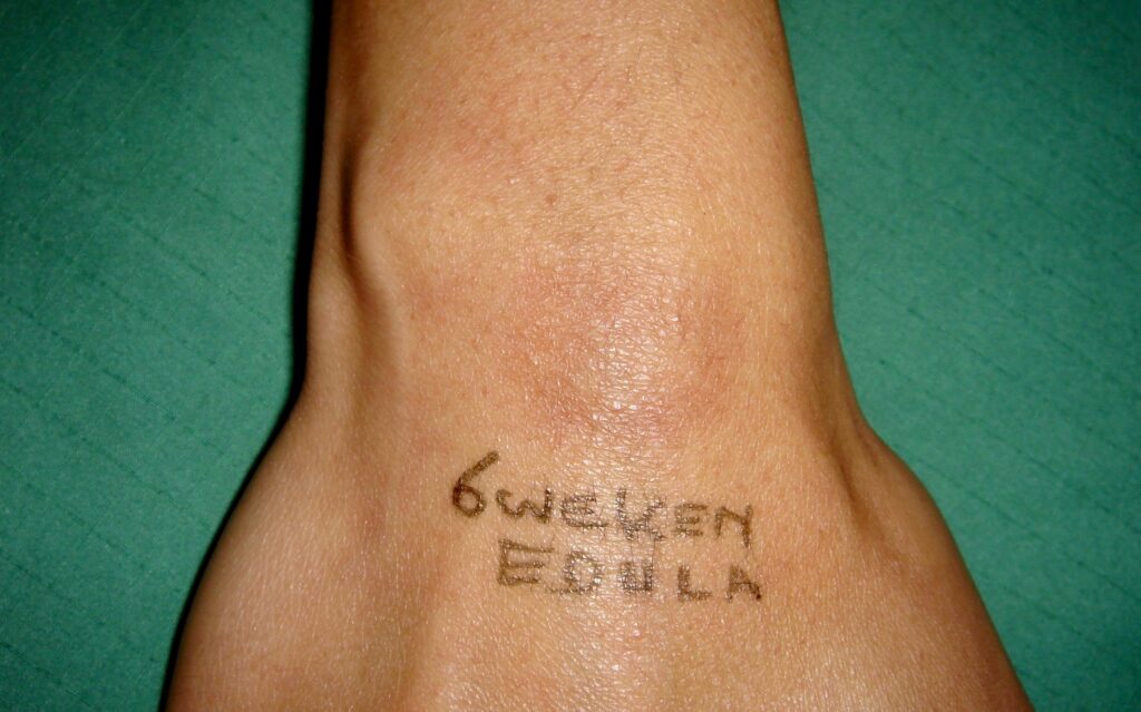 Lipoom (vetbult) op pols verwijderd, resultaat na 6 weken gebruik van Edula® Zalf.