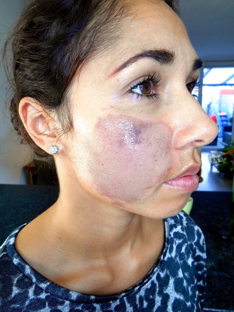 getinte dame, Na 1 dag gebruik van Edula® Zalf, na een chemische peeling in het gezicht