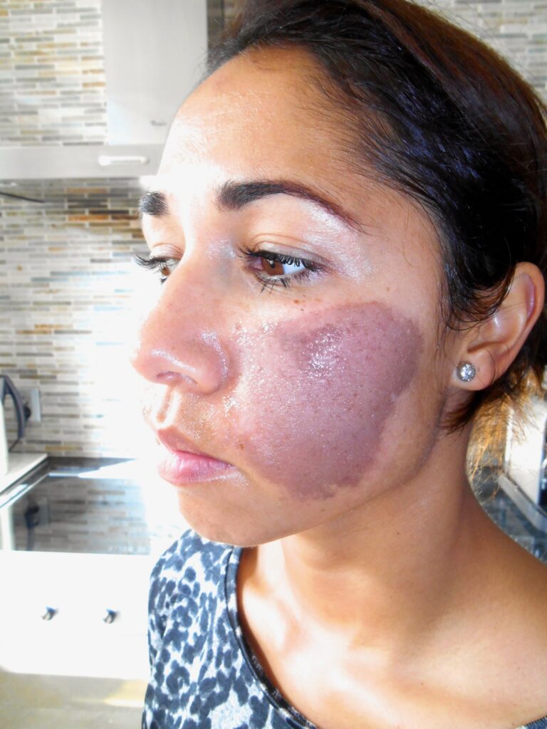 getinte dame, Na 1 dag gebruik van Edula® Zalf, na een chemische peeling in het gezicht