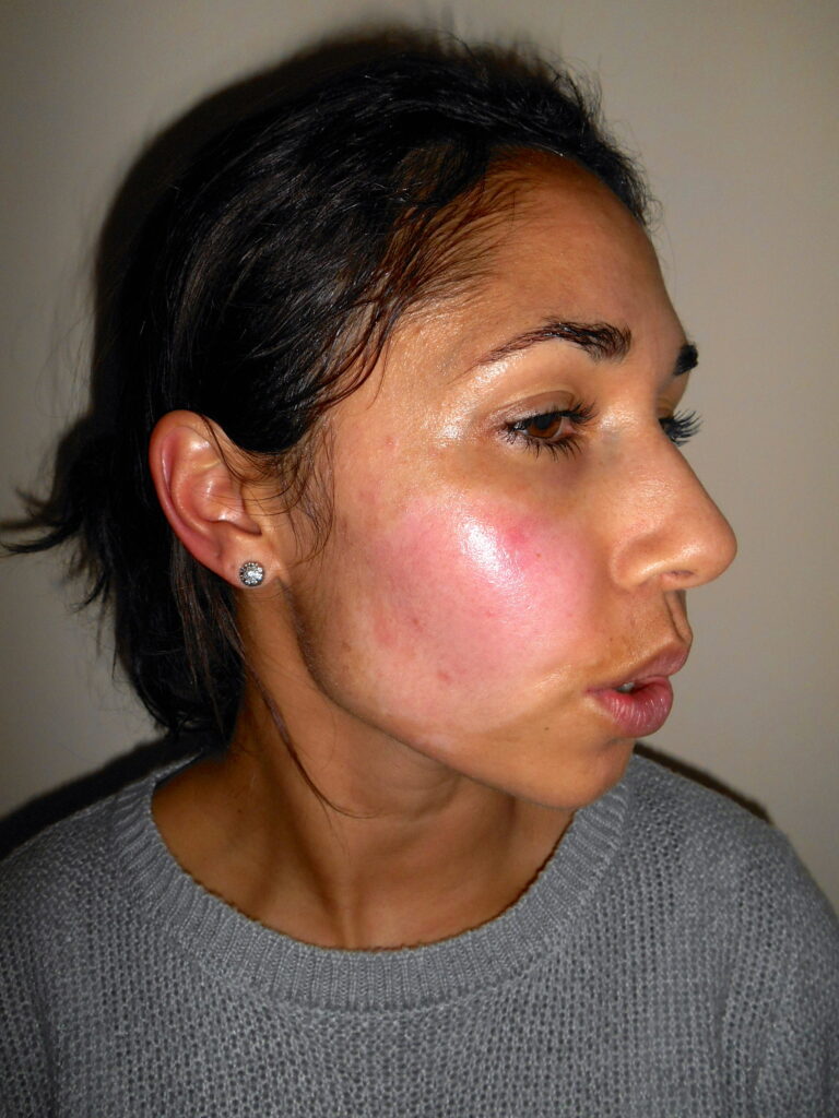 getinte dame, Na 9 dagen gebruik van Edula® Zalf, na een chemische peeling in het gezicht