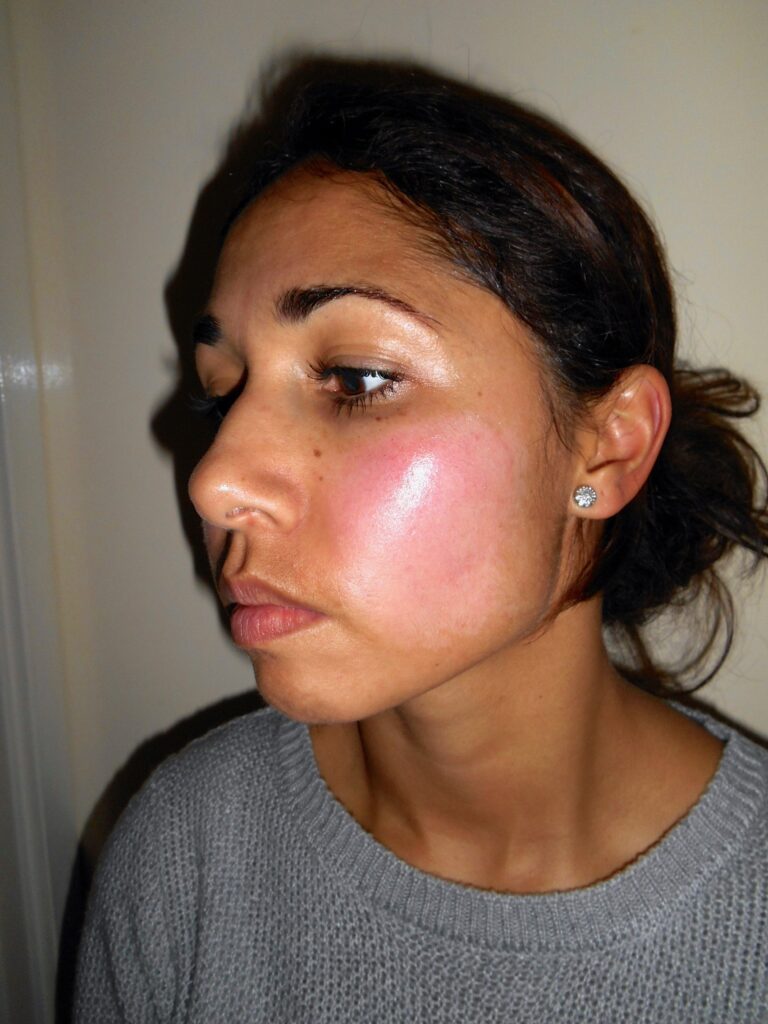 getinte dame, Na 9 dagen gebruik van Edula® Zalf, na een chemische peeling in het gezicht