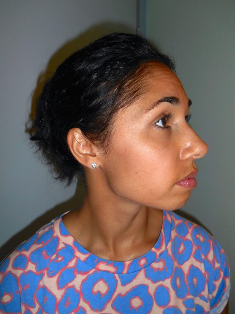 chemische peeling in gezicht, eindresultaat na 4 maanden gebruik van Edula® Zalf, niets terug te zien van de pigmentvlekken en de huid is mooi geheeld.