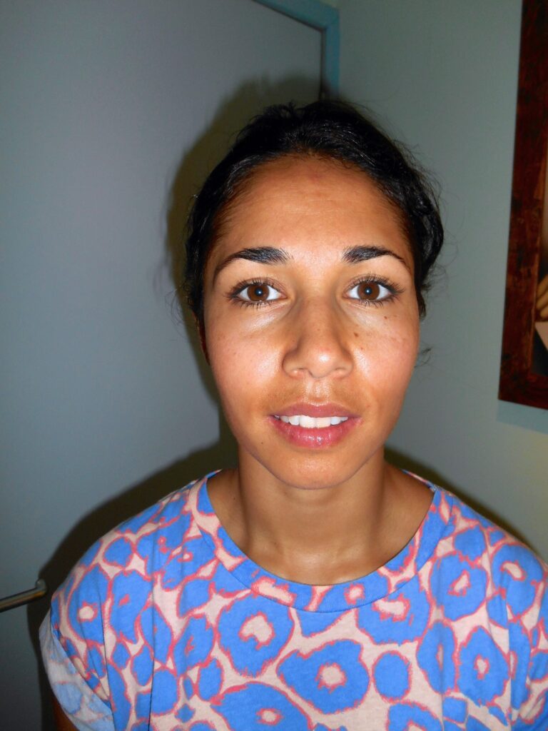 chemische peeling in gezicht, eindresultaat na 4 maanden gebruik van Edula® Zalf, niets terug te zien van de pigmentvlekken en de huid is mooi geheeld.