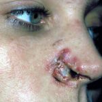 Vrouw 2 dagen na hondenbeet in de neus, wond is gaan infecteren.