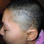 Vrouw na 2 maanden dagelijks Edula® Zalf op het litteken na een hersenoperatie.