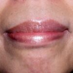 Vrouw met allergische reactie van de mondhoeken, resultaat na 3 dagen Edula® Zalf.