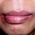 Vrouw met allergische reactie van de mondhoeken