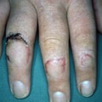 Postoperatief na trauma met een cirkelzaag aan de ringvinger