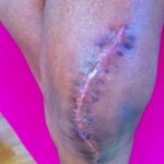 Groot litteken op de knie, resultaat na een 1,5 maand dagelijks gebruik van Edula® Zalf onder occlusie van een gaas.