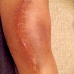 Groot litteken op de knie, resultaat na 3 maanden dagelijks gebruik van Edula® Zalf onder occlusie van een gaas.