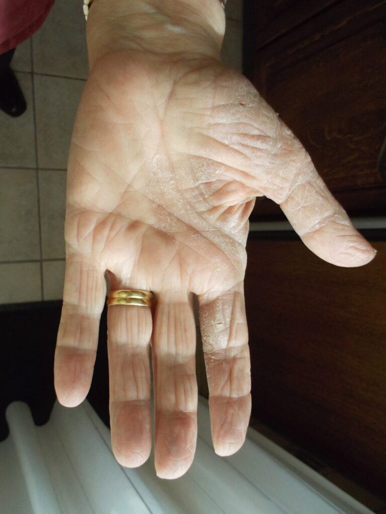 Ernstige vorm van eczeem, na 2 weken dagelijks gebruik van Edula® Zalf.