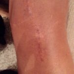 Groot litteken op de knie, resultaat na 4 maanden dagelijks gebruik van Edula® Zalf onder occlusie van een gaas.