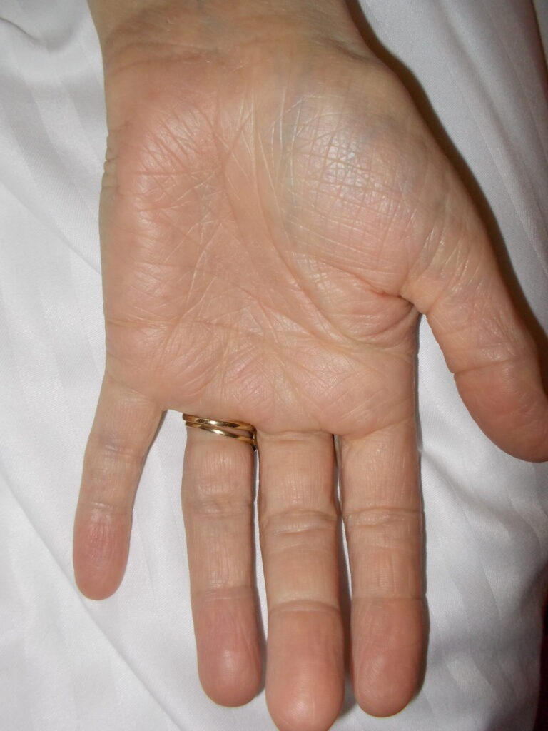 Ernstige vorm van eczeem, eindresultaat na 3 weken dagelijks gebruik van Edula® Zalf.