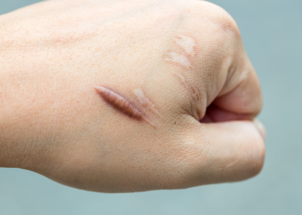 keloïd litteken op een hand