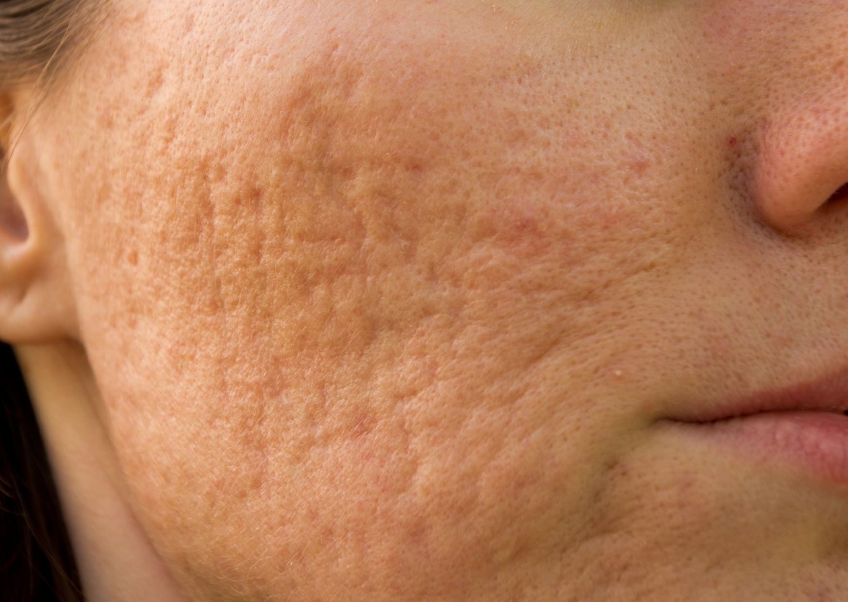 Atrofisch litteken op de wang van een vrouw, ontstaan door acne