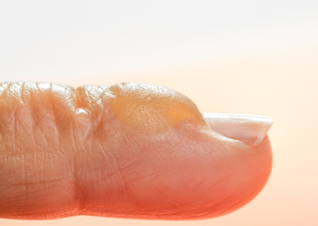 een brandblaar op de vinger