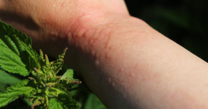 Brandnetel jeuk ontstaat meestal direct na aanraking. Ook roodheid en bultjes komen vaak voor. 
