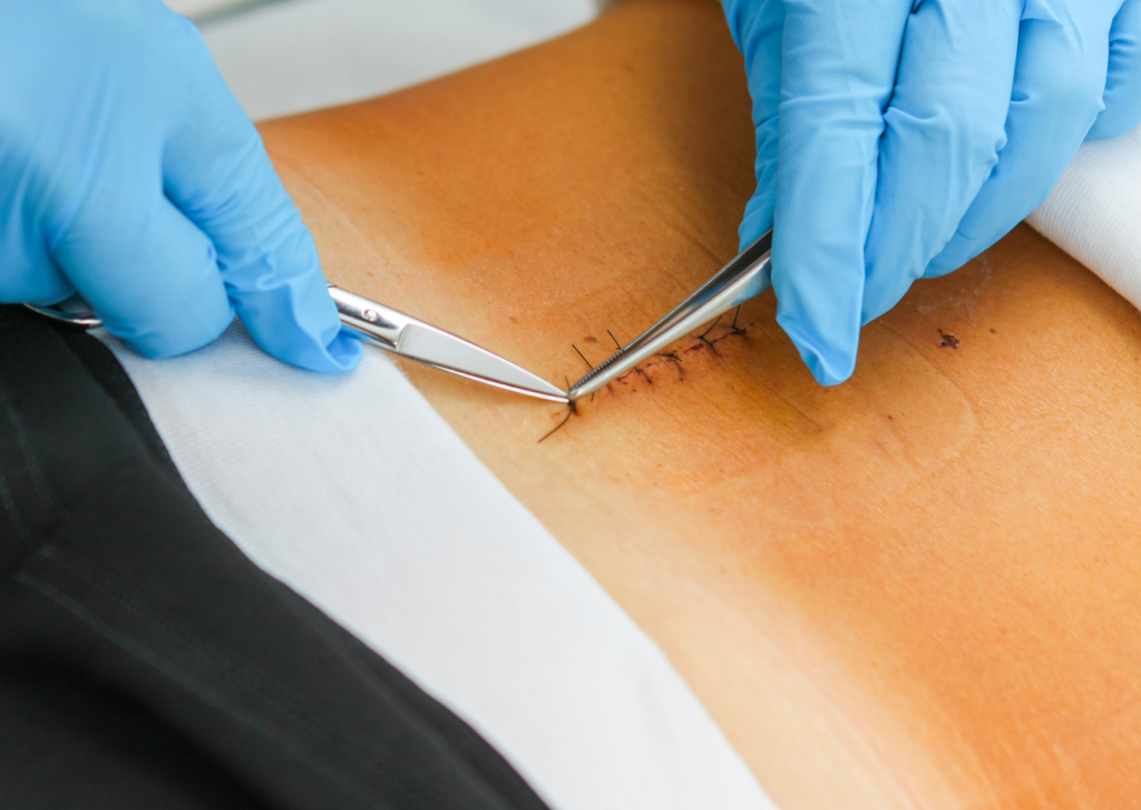 hechtingen verwijderen