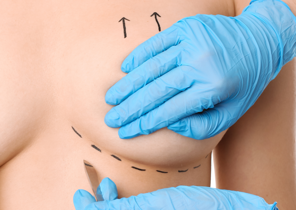 Littekens borstvergroting voorkomen met Edula® Zalf