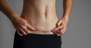 Littekenweefsel masseren: zodra het litteken gesloten is en de korstjes verdwenen kan je beginnen met masseren