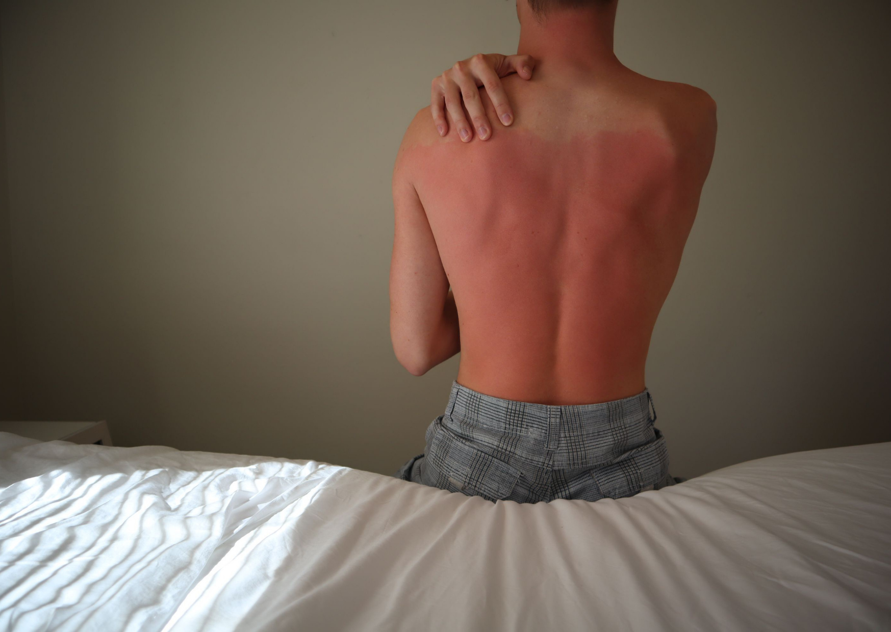 Zonschade huid herstellen, man met een zonverbranding op de rug