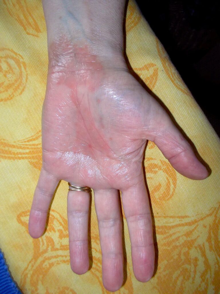 dame met eczeem aan haar hand, resultaat na 6 weken dagelijks gebruik van Edula® Zalf