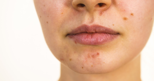 Puistjes ronde mond vallen vaak onder acne, maar ook dermatitis perioralis komt regelmatig voor