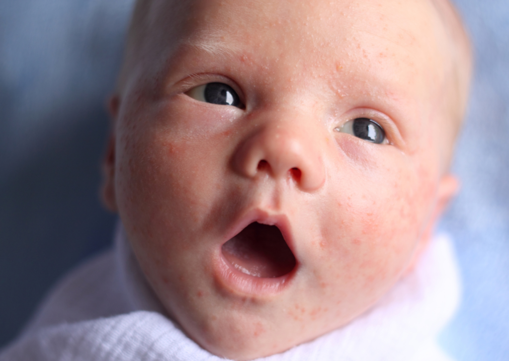 pukkeltjes baby, ook wel baby acne genoemd