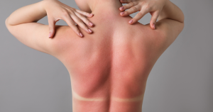 zonschade huid herstellen: Wanneer je huid verbrand is door de zon is deze vaak rood, geïrriteerd, droog en trekkerig.  