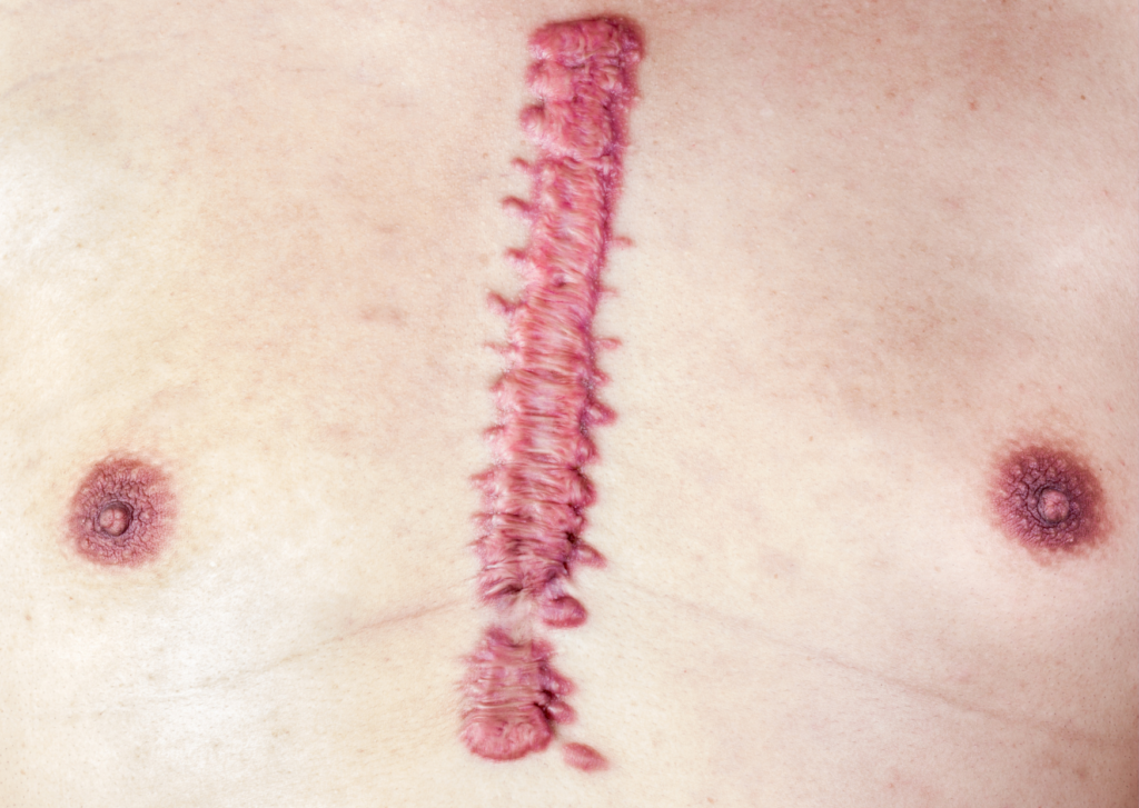 een dik hypertrofisch litteken op de borst van een man