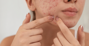Acne ontstaat vaak door een combinatie van talg, bacteriën en verstopte haarzakjes, waardoor puistjes en ontstekingen kunnen ontstaan.