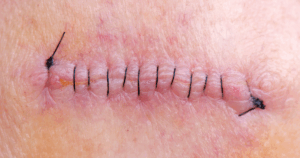 hechtingen verwijderen: Dit is een voorbeeld van een niet-resorbeerbare hechting die later handmatig verwijderd moet worden