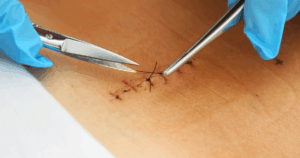 Laat hechtingen altijd door een arts of professional verwijderen