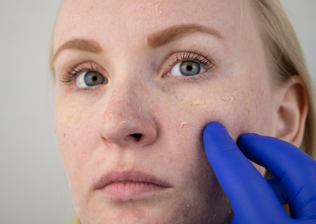 schilfers in het gezicht van een jonge vrouw