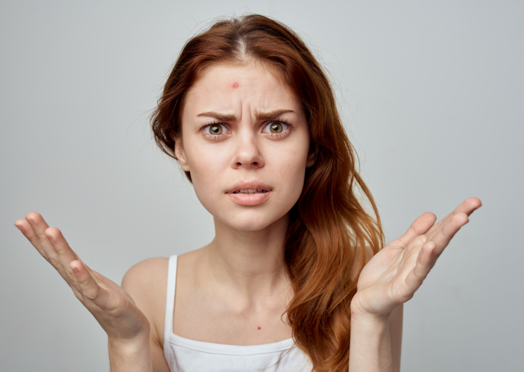 snel van puistjes afkomen, een jonge dame met een puist op haar voorhoofd