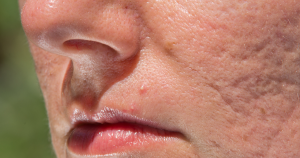 Litteken laseren: Vooral mensen met acne littekens hebben baat bij een laser behandeling.