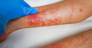 Symptomen van hypostatisch eczeem.