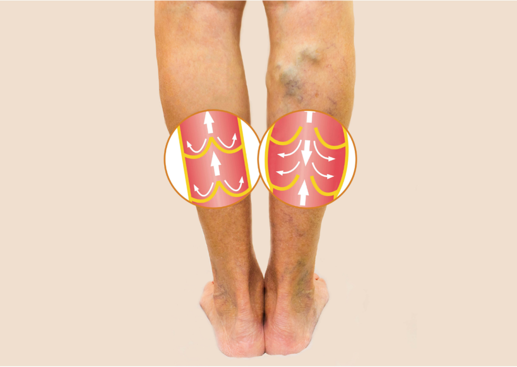 hypostatisch eczeem, illustratie van de bloedafvoer in de onderbenen